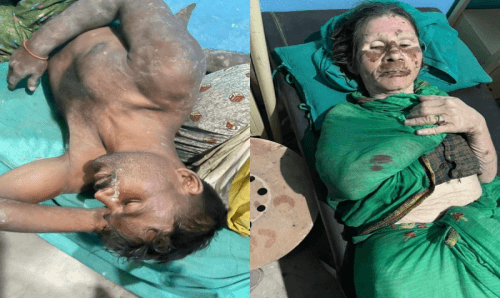 वडाध्यक्ष यादवको गुण्डागर्दीः गुण्डा लगाएर गरिबमाथि साँघातिक आक्रमण