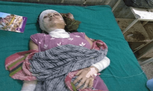 किशोरी एसीड प्रहार प्रकरण : उपचारको लागि प्रदेश सरकारको ५ लाख