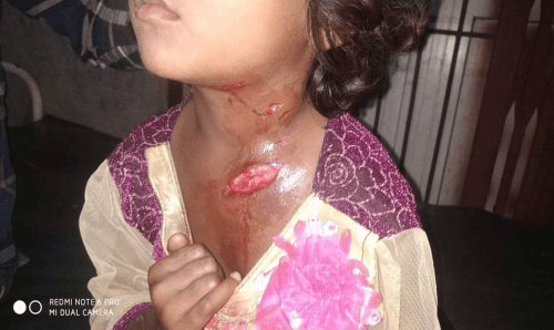महोत्तरीमा बौलाहा कुकुरले ५० जनाबढीलाई टोके !